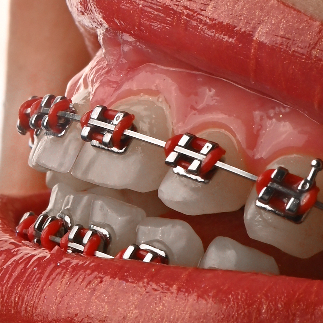 براکت فلزی American Orthodontics - 13