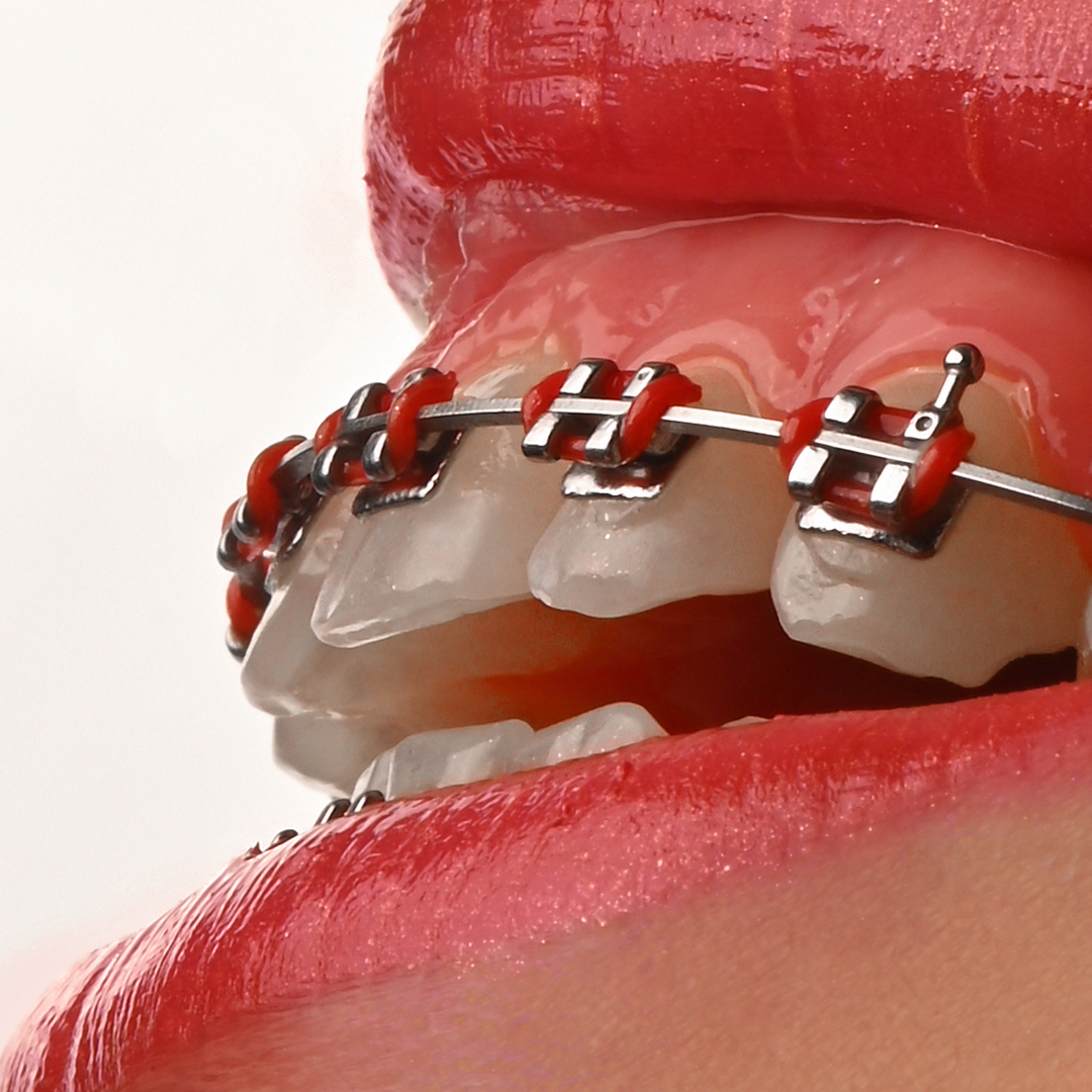 براکت فلزی American Orthodontics - 7