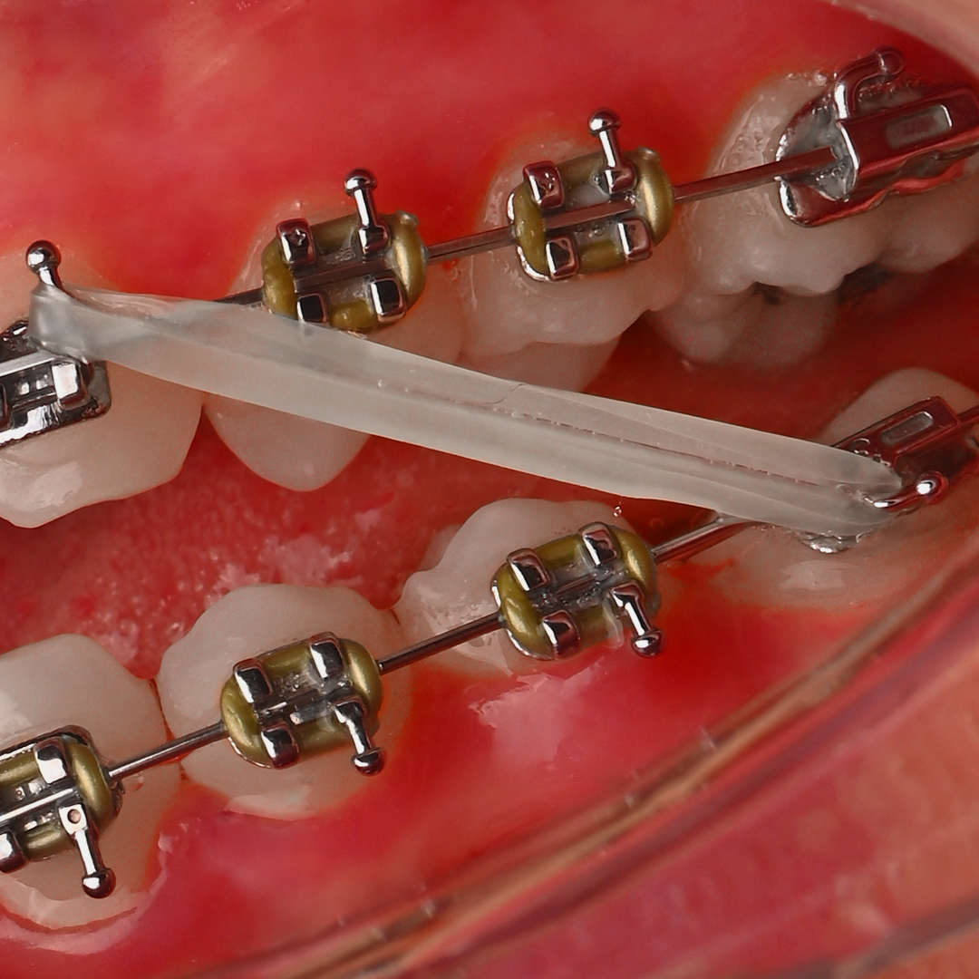 براکت فلزی American Orthodontics - 21