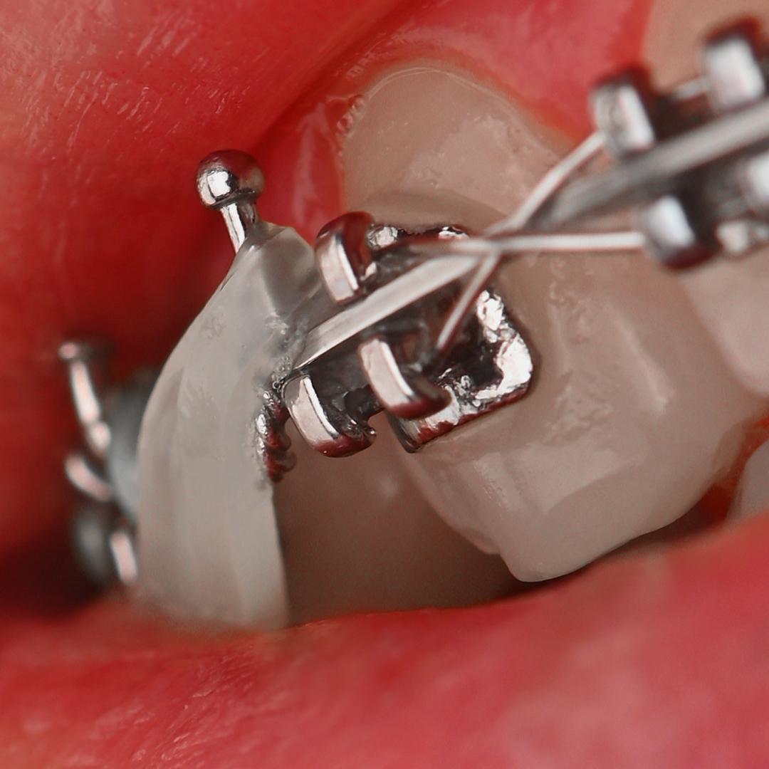 براکت فلزی American Orthodontics - 22