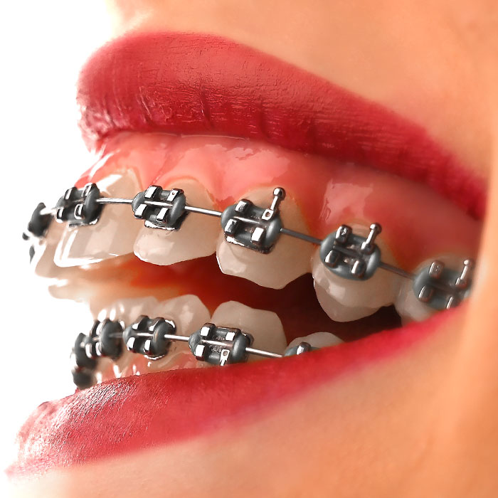 براکت فلزی American Orthodontics - 25