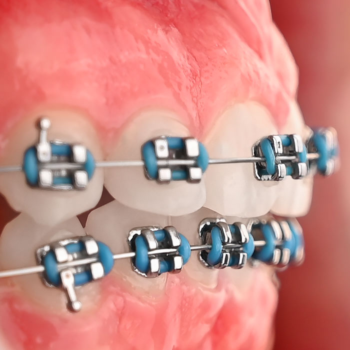 براکت فلزی American Orthodontics - 19