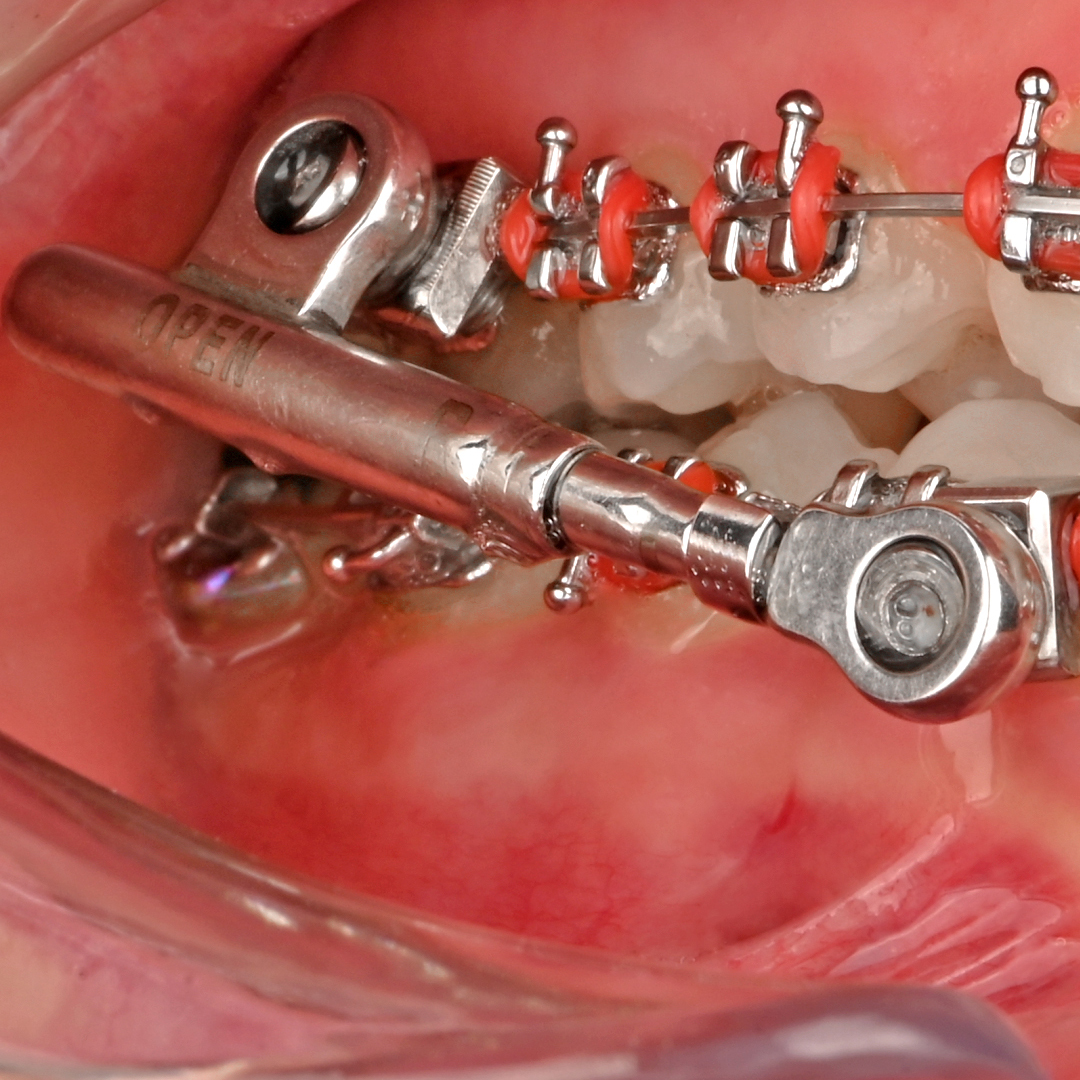 پاور اسکوپ 2 American Orthodontics - 9